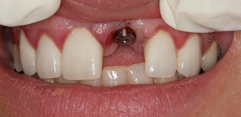 dental-implants gallery