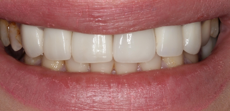 dental-implants gallery