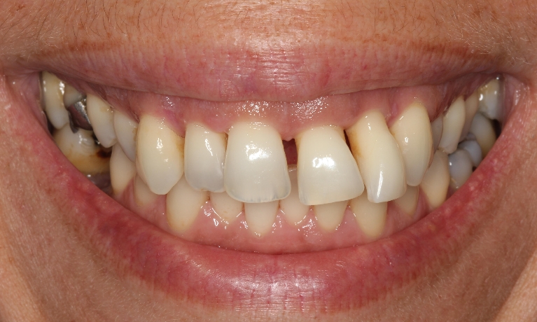 implant-teeth gallery