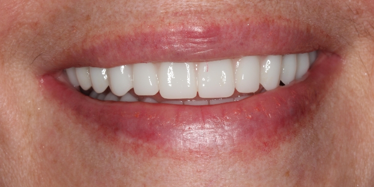 implant-teeth gallery