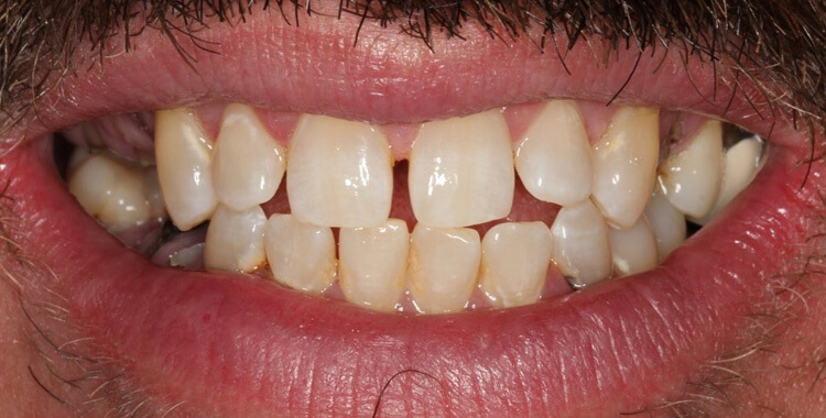 Before