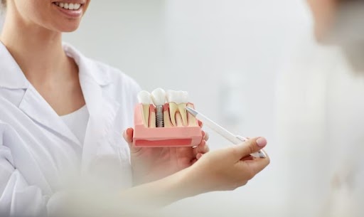 Dental Implants
