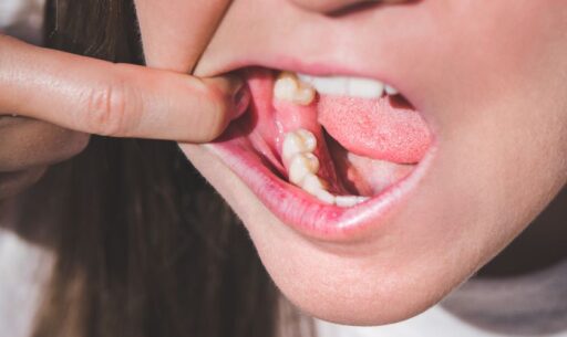 wisdom teeth removal
