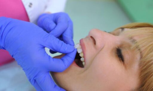 dental veneers