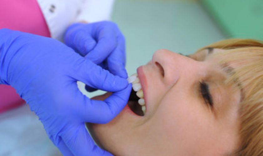 dental veneers
