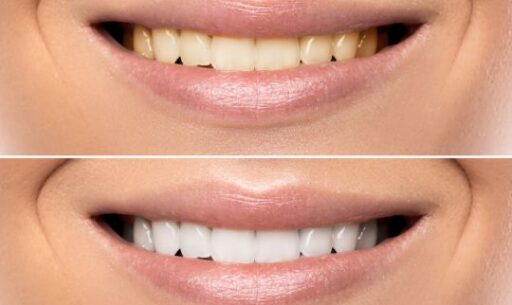 Teeth Whitening in Chandler