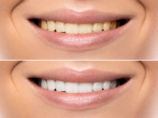 Teeth Whitening in Chandler