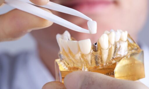 Dental Implants Lake Worth