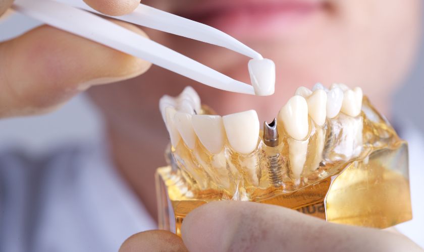 Dental Implants Lake Worth