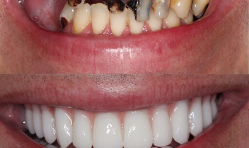 Teeth-in-a-Day vs. Dentures