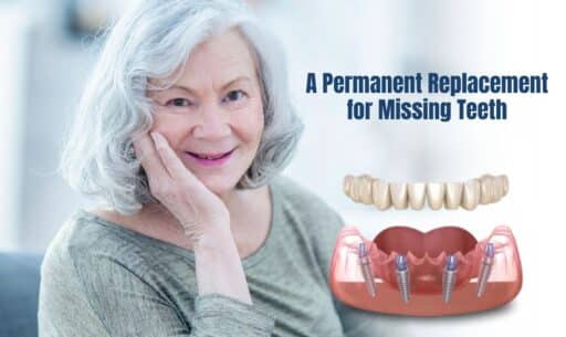 A Permanent Replacement for Missing Teeth
