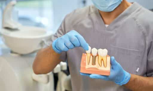 Dental Implants