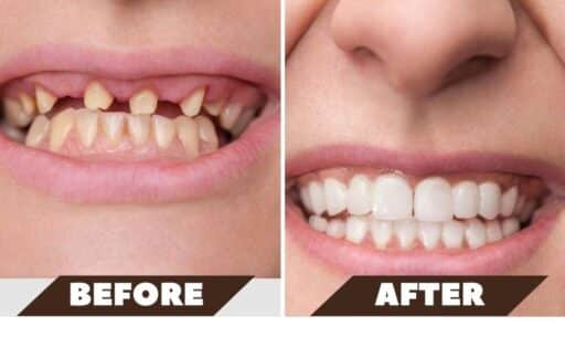 dental implant surgery