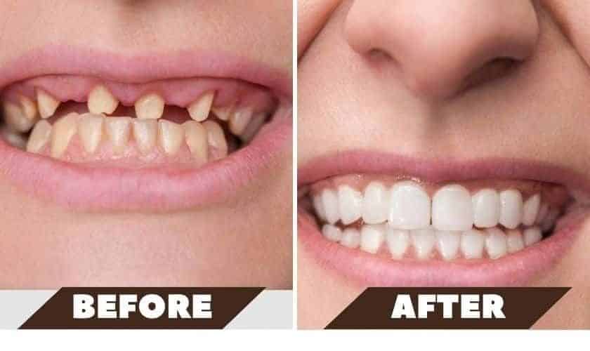dental implant surgery in lake worth