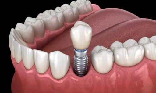 Dental Implants Are Beneficial for Oral Health