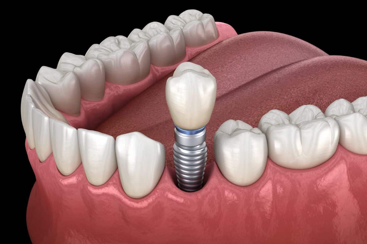 Dental Implants Are Beneficial for Oral Health