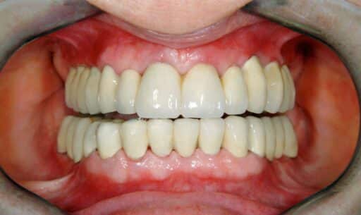 Step-by-Step Guide to Full-Mouth Reconstruction Procedures