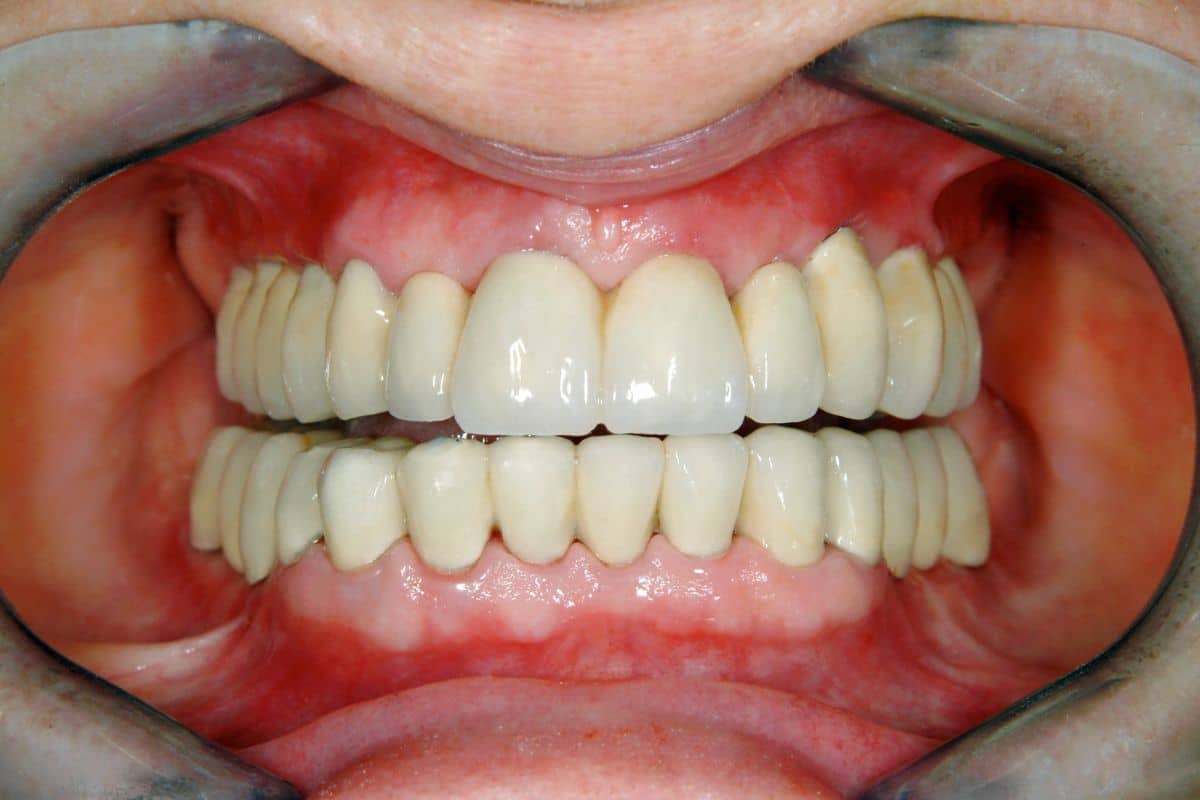 Step-by-Step Guide to Full-Mouth Reconstruction Procedures