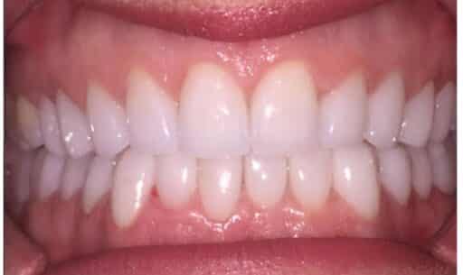 Full Mouth Reconstruction Take