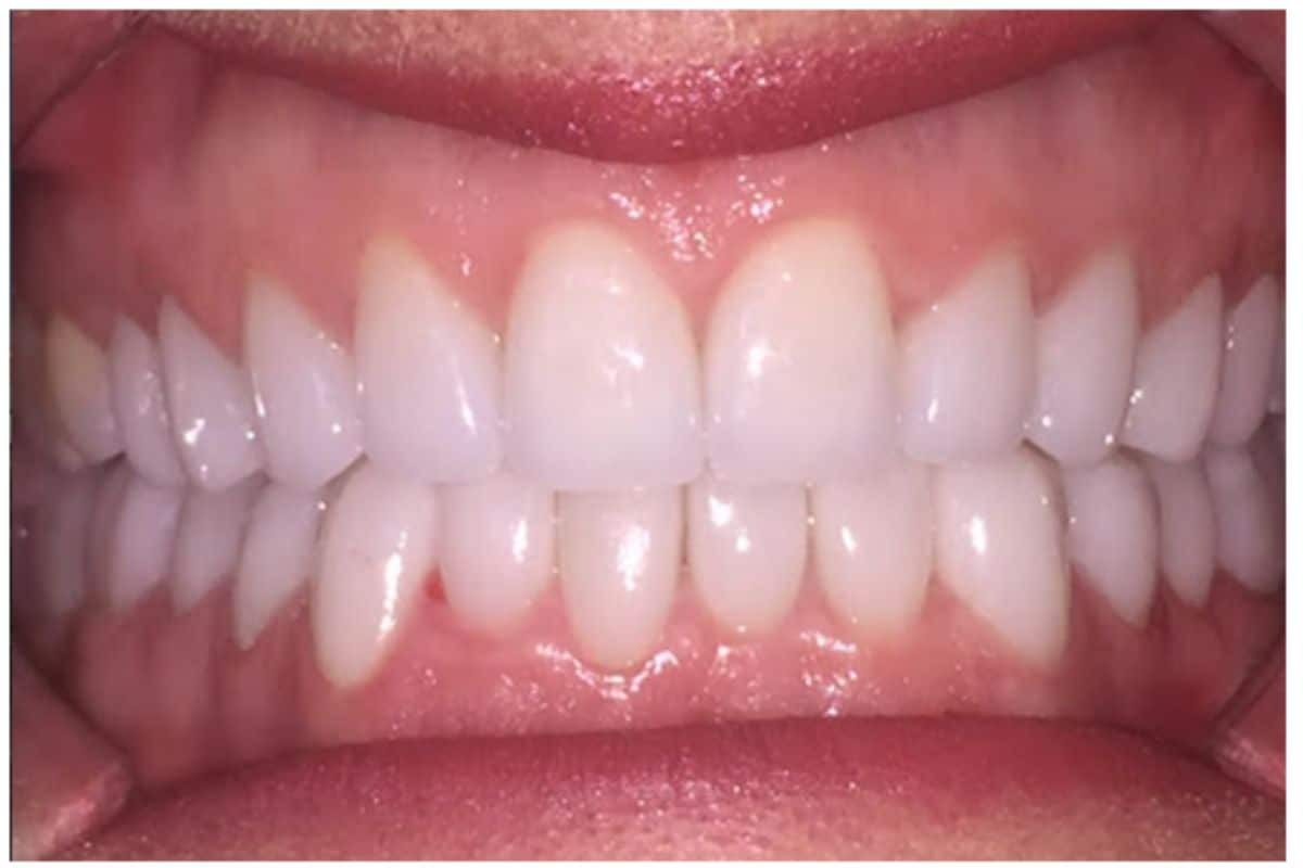 Close-up of completed full mouth reconstruction showing aligned upper and lower teeth with natural appearance.