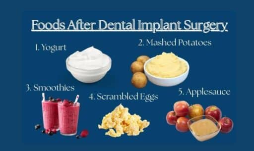 Dental Implant Recovery Diet: Foods to Eat & Avoid