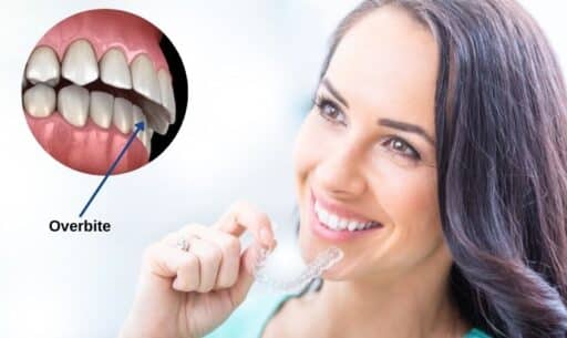 Invisalign Fix Overbites Problems