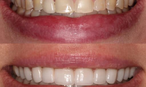 Veneers Lake Worth, FL
