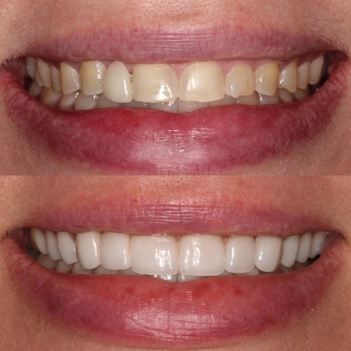Veneers Lake Worth, FL