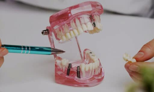 teeth in a day at Palms Dental Care