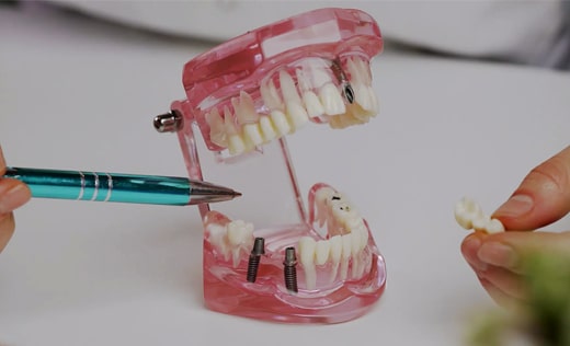 teeth in a day at Palms Dental Care