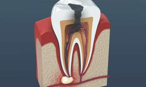 Can Root Canal Retreatment Save a Tooth with Severe Decay