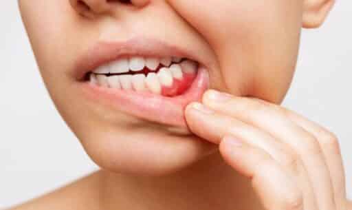 How Long Can You Keep Your Teeth with Periodontal Disease
