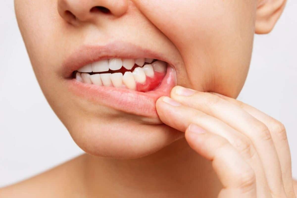 How Long Can You Keep Your Teeth with Periodontal Disease