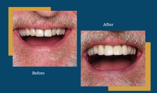 Should You Visit Your Dentist Before or After Christmas