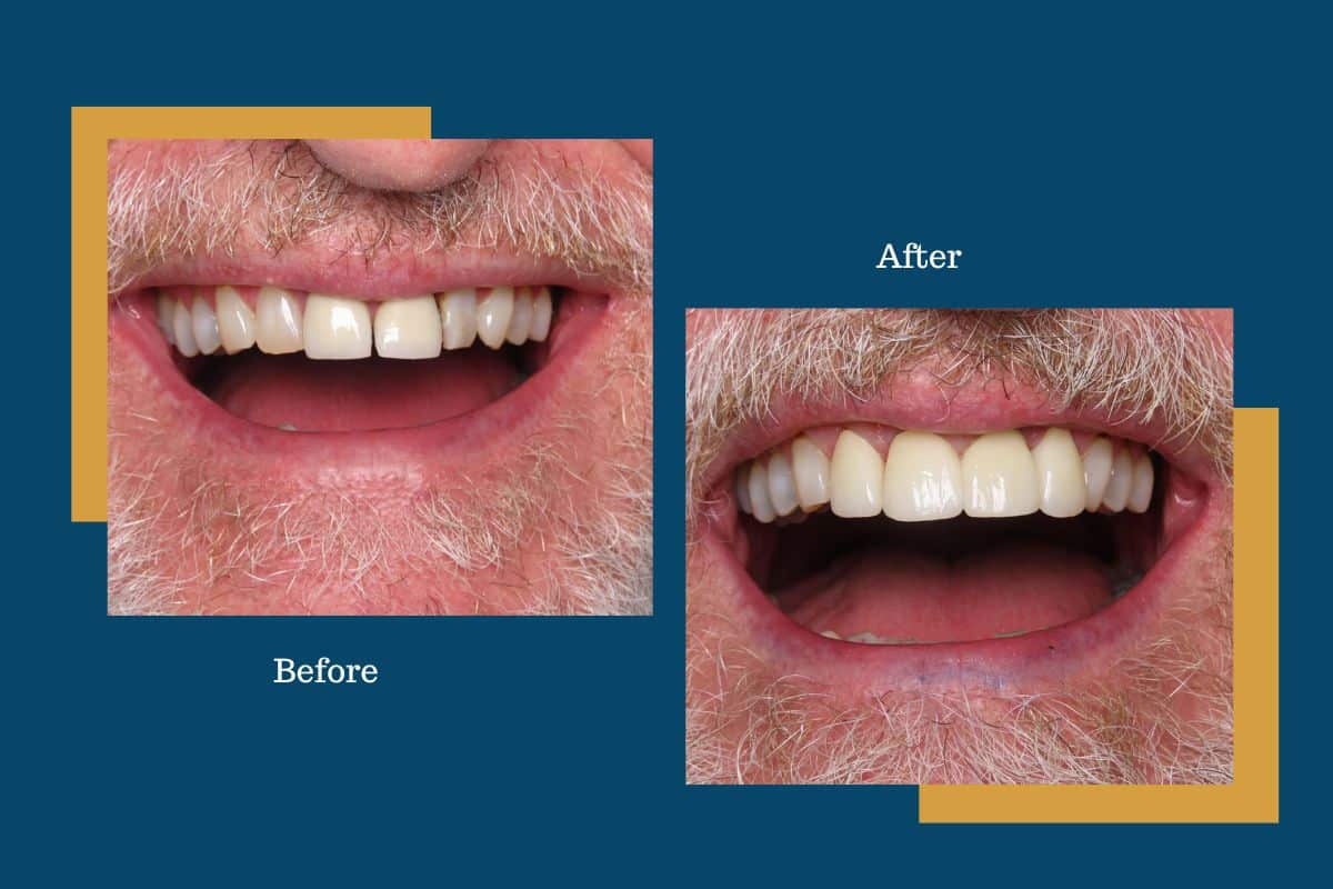 Should You Visit Your Dentist Before or After Christmas