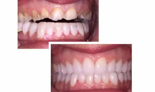 Top 5 Dental Issues Corrected in Full Mouth Reconstruction