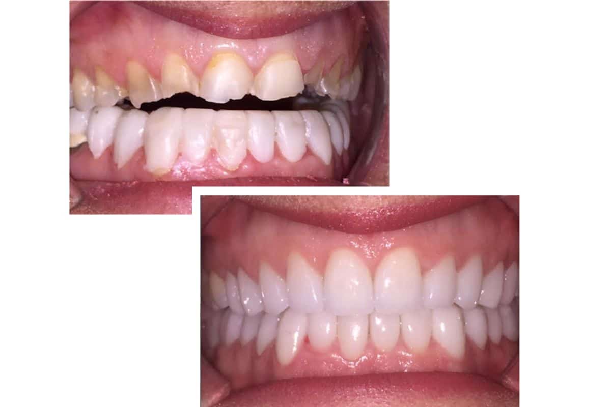 Top 5 Dental Issues Corrected in Full Mouth Reconstruction