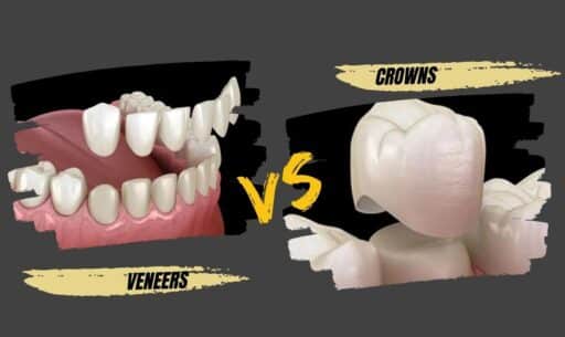 Do’s and Don’ts After Getting Veneers or Crowns