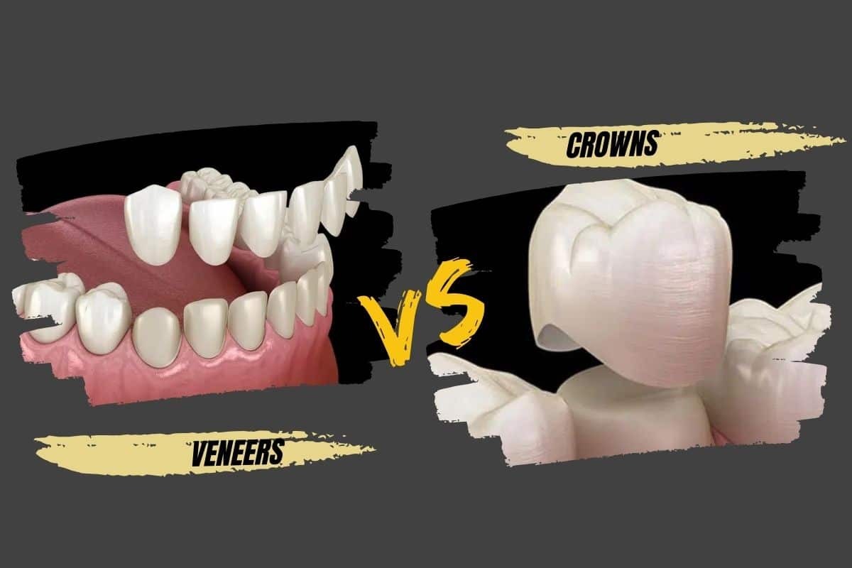 Dental veneers versus crowns comparison showing tooth restoration options in Wellington.