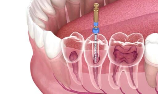 How Rotary Endodontics Reduces the Risk of Complications During Root Canals