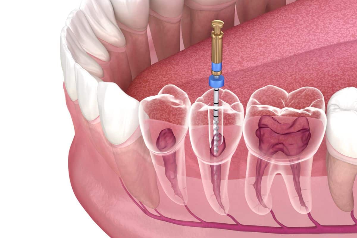 How Rotary Endodontics Reduces the Risk of Complications During Root Canals