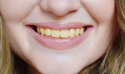 Yellow Teeth White Again
