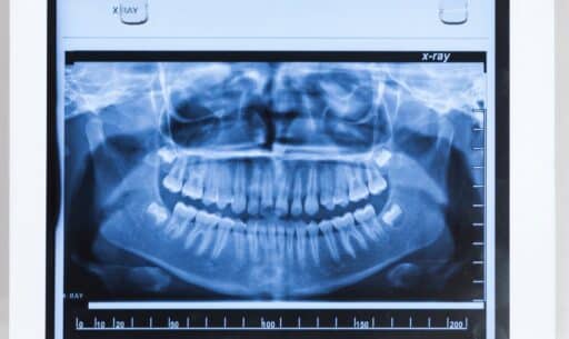 Bone Loss in Your Jaw