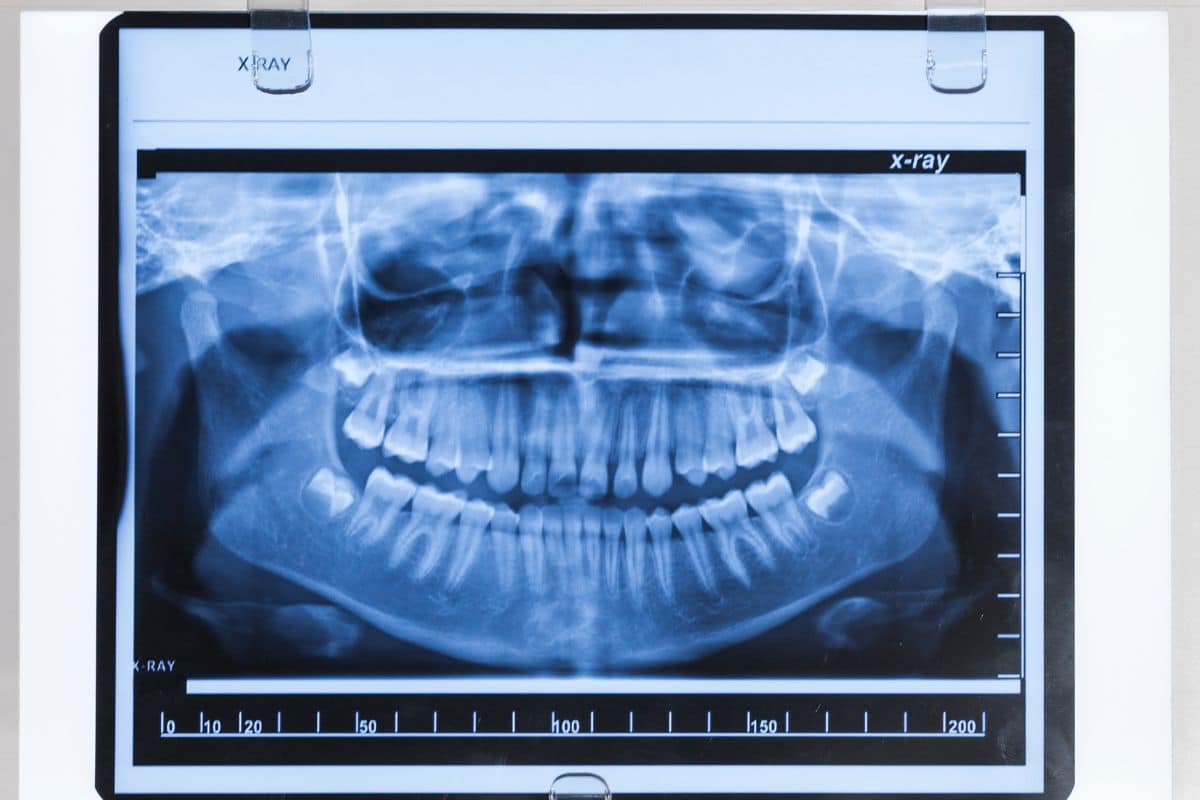 Bone Loss in Your Jaw