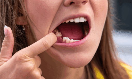 Tooth extraction recovery explained