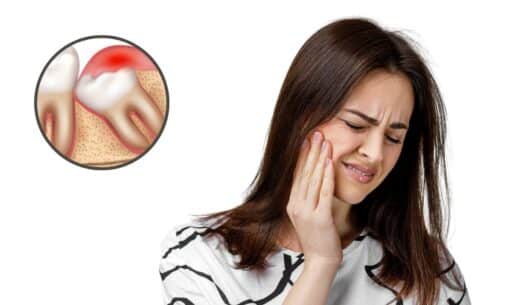 Smooth Recovery After a Non-Surgical Wisdom Tooth Extraction