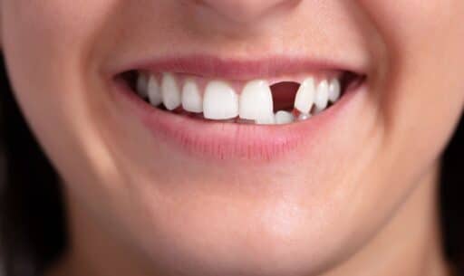 Missing Front Tooth