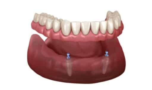 Replace Full Dentures