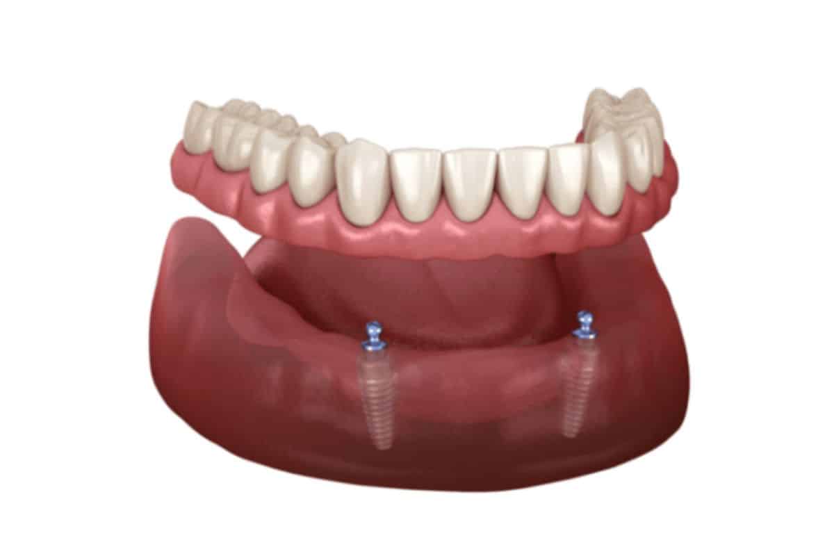 Replace Full Dentures