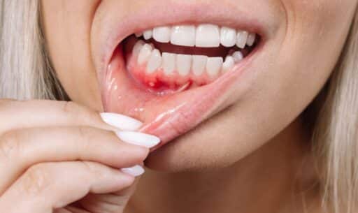Do You Need Periodontal Treatment? Common Signs of Gum Disease
